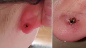 Image result for Tick Removal