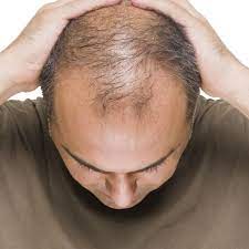Some types of hair loss are permanent, like. Our Son Says His Hair Loss Has Ruined His Life