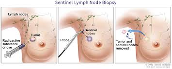 Lymph Nodes And Breast Cancer