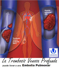 Arterial embolism of the extremities and technique of embolectomy. Tvp Trombosis Venosa Profunda Varicenter Guatemala Facebook