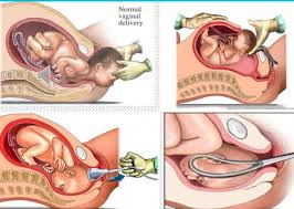 Image result for Forceps Assisted Delivery
