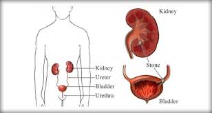 Urolithiasis Renal Calculi Kidney Failure Symptoms Renal Enlarged Kidney