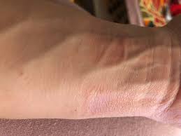 Leo says that nickel can cause a rash, and there is no nickel in it. Skin Rash Caused By Apple Watch Strap Apple Community