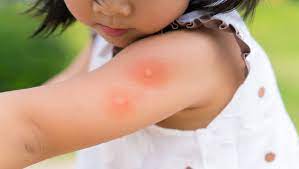 Alergia A Picada De Mosquitos Alergolife Clinica De Alergia Asma E Imunologia