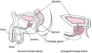 But women don't actually have a prostate gland. Benign Prostatic Hyperplasia Bph Men S Health Issues Msd Manual Consumer Version