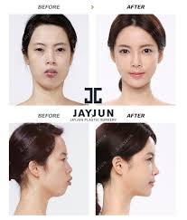 Korean Face Contouring Makeup Korea Facial Contouring Korea Facial Contouring Surgery Before And After Ko Face Contouring Makeup Facial Contouring Face Surgery
