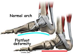 Physical Therapy In Lansing For Foot Tarsal Tunnel Syndrome