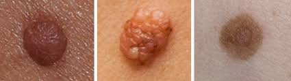 The melanoma pictures give you an idea of what melanoma skin cancer can look like. How Do I Know If It S Melanoma Molemap Australia