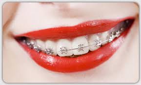 What is wrong with using length inside an enclosing brace {.} ? Types Of Braces Art Of Orthodontics