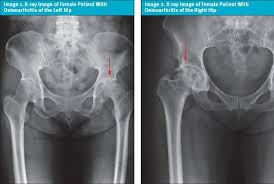 Image result for Hip XRay