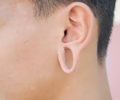 Skin cancer is the most common type of cancer in the united states by a pretty large margin, and it does not discriminate. Earlobe Repair Surgery Santa Rosa Sonoma Napa Marin County Petaluma Ca