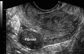 Jangan takut kena bedah kalau ada yang menghadapi ketumbuhan dalam perut sebab kalau dibiarkan akan beri kesan pada di pinggang, urat dan seluruh badan. Fibroid Ketumbuhan Paling Kerap Berlaku Pada Rahim Yang Boleh Membahayakan Iluminasi
