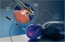 Check spelling or type a new query. A New Method Using Raman Spectroscopy For In Vivo Targeted Brain Cancer Tissue Biopsy Scientific Reports