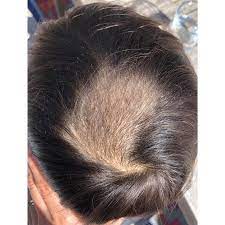 Mayoclinic.com says that hair loss can be caused by a poor diet, especially one that is low in protein, vitamins, and minerals. Cureus Combined Diet And Supplementation Therapy Resolves Alopecia Areata In A Paediatric Patient A Case Study