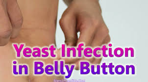 Yeast Infection In Belly Button Causes Symptoms