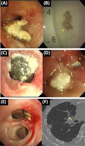 Image result for Broncholithiasis
