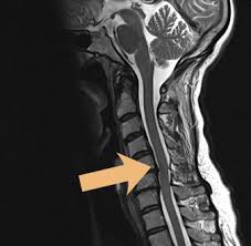 Spinalstenose Spinalkanalstenose Beta Klinik Bonn