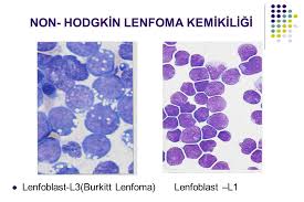 Ana tedaviler tek başına veya kombine olarak kemoterapi ve radyasyon vardır. Non Hodgkin Lenfoma 4 Evre