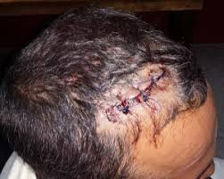 I always feel it and if anything hits the entry or exit points or the scar from surgery to remove bullet fragments it send weird tingles up my leg. Bullet Grazed Diamond Man Recovering Kaieteur News