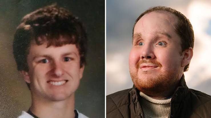 The sun will rise tomorrow': US man says he's been given second chance  after face transplant | ITV News