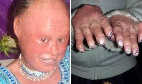 A review of clinical and molecular findings in 45 cases. Woman Who Sufferers With Rare Skin Condition Called Harlequin Ichthyosis Express Co Uk