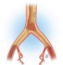 Endovascular Treatment Of Aortoiliac Disease Thoracic Key