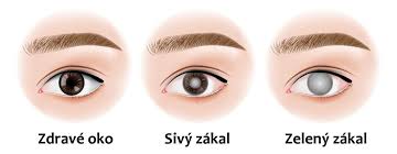 Maybe you would like to learn more about one of these? Glaukom Zeleny Zakal Ake Su Jeho Priciny A Priznaky Zdravovek