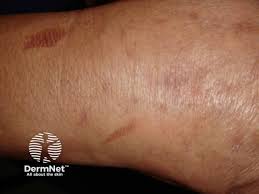 Image result for Postinflammatory Hyperpigmentation