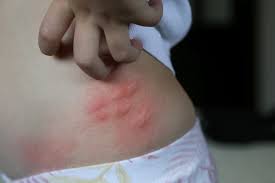 Image result for mosquito bite