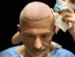 Considering the most number of coverage, it would have costed me more than buying a car. Celebrities With Hair Transplant Elon Musk And David Silva Rephair
