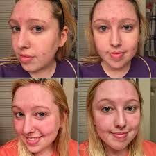 The roles of vitamin c in skin health. harvard health publishing/harvard medical. People Say This 20 Vitamin C Serum Completely Cleared Up Their Skin