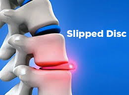 We are doing our best to ensure that slipped disc is free to all readers. Rawatan Slip Disc Tanpa Perlu Pembedahan Info Bemanfaat