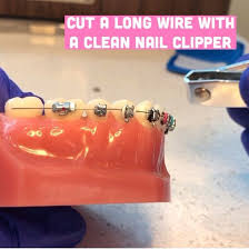 Cut the braces wire gently. Greenpoint Orthodontics How To Cut A Long Wire With A Nail Clipper Facebook