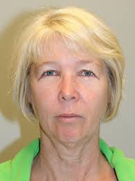 Facial Implants Palo Alto