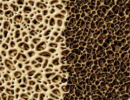 New Drug Hope For Rare Bone Cancer Patients Drug Discovery And Development