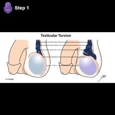Image result for Cremasteric Reflex