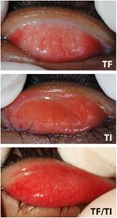 Image result for Chlamydia Trachomatis