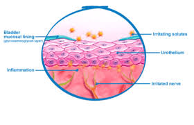 Image result for Interstitial Cystitis