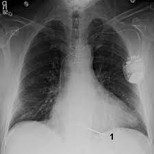 What is an implantable cardioverter defibrillator (icd)? Implantierbarer Kardioverterdefibrillator Icd Herz Kreislauf Krankheiten Msd Manual Profi Ausgabe