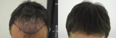 Autotrapianto di capelli a torino milano. Istituto Helvetico Sanders All Avanguardia Negli Interventi Di Trapianto Capelli F U E