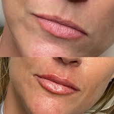 Meet Your Injector: A Conversation with Texas Nurse Meaghan