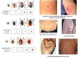 Tick Andtick And Rash Pictures Rash Pictures What Is Lyme