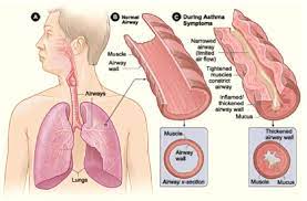 16 4 Disorders Of The Respiratory System Biology Libretexts