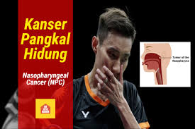 Apa yang menentukan jangka hayat pesakit kanser? Apa Itu Kanser Pangkal Hidung Atau Nasopharyngeal Cancer Npc