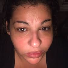 After Specialty Facial Red Light Therapy Chemical Peel Microdermabrasion Deep Exfoliation Deep Cleansing Deep Exfoliation Red Light Therapy Chemical Peel