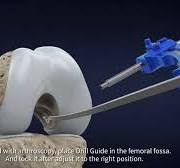 👉✨Introducing the Double Medical Knee Reconstruction and ...