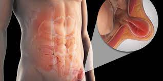 Groin Hernia Inguinal Hernia And Femoral Hernia In Adults Denzil May