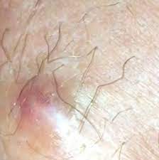 Tmi What Is This It S Extremely Painful It S On The Inside Of My Butt Cheek Closer To My Vagina Than My Anus I M 39 Weeks Pregnant Could It Be A Hemorrhoid Post