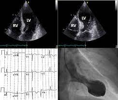 It is easy to measure the distance between two peaks (maximum) or two lows (minimum). Standard And Advanced Echocardiography In Takotsubo Stress Cardiomyopathy Clinical And Prognostic Implications Journal Of The American Society Of Echocardiography