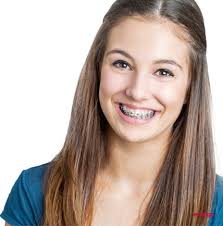 Tips to Maintain a Good Oral Hygiene While Wearing Dental Braces